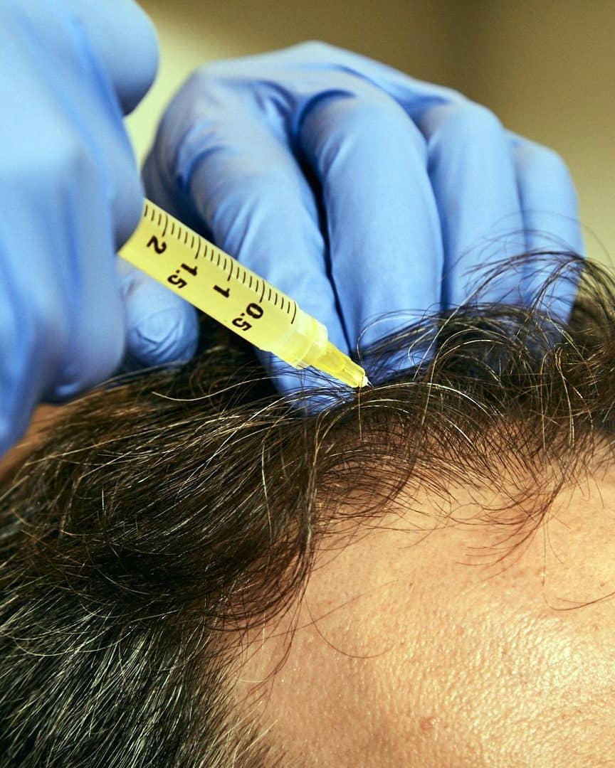 Caída del pelo en Spazio, Palermo